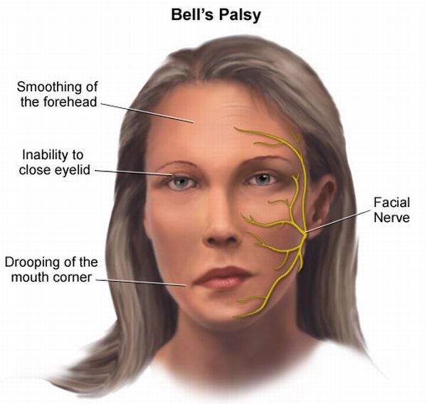 bellspalsy_facial paralysis