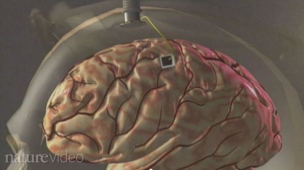 braingate-implant