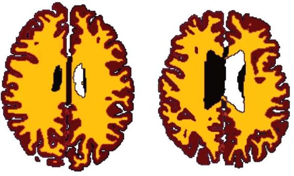 brain-ageing-white-matter