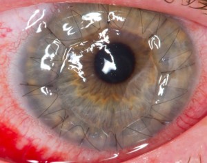 Regeneration of Eye’s Outermost Layer via Hydrogel Films: Corneal Transplantation