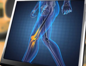 3D Bioprinting Would Help Bones Regenerate Without Using Grafts: Printing Prosthetics