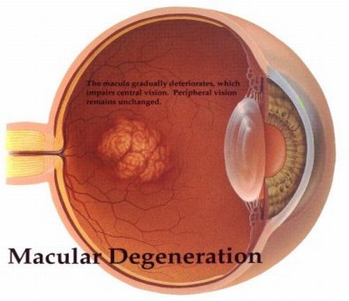 macular_degeneration