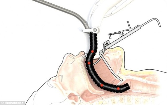 Flex system, inserted through mouth and reaching throat