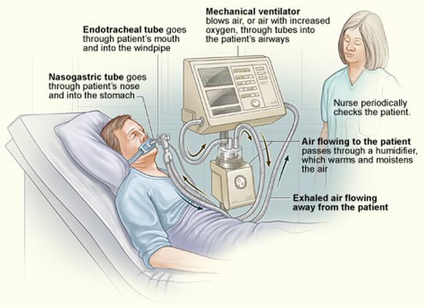 lung-ventilators
